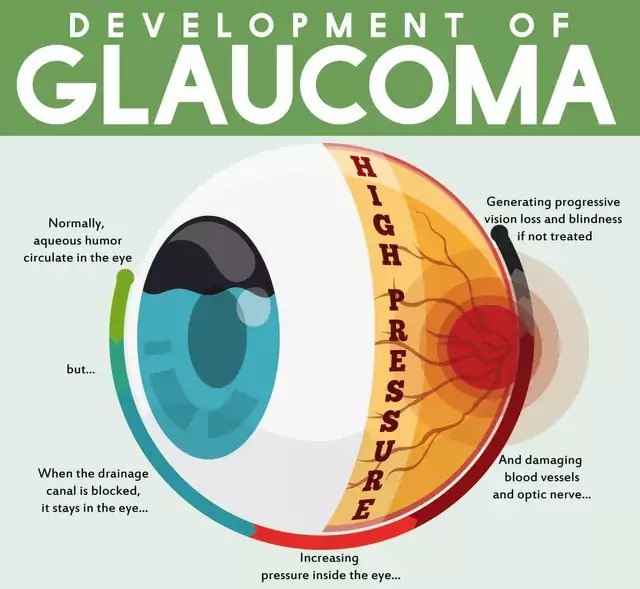 Meeting on Preventing Glaucoma Blindness